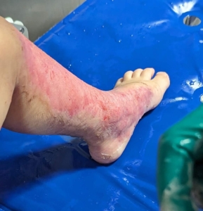 Burns on a child's leg