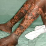 Non-burn skin loss condition